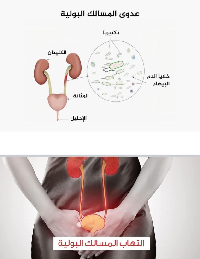 ما أسباب إلتهــابات المســالك البــولية (Urinary Tract Infection) المتكــررة؟