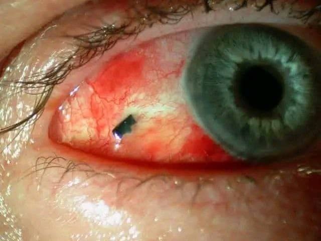 ما ثواب إزالة الأذى من العين؟