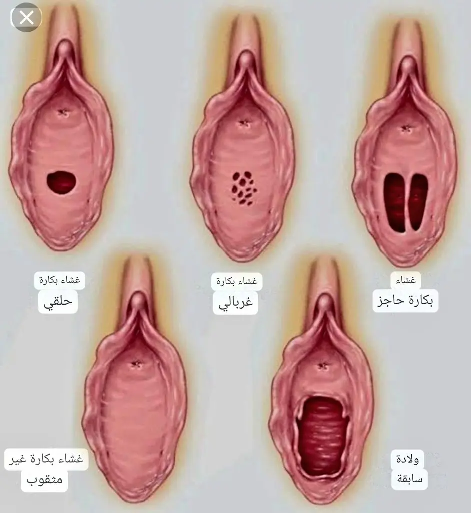 نزول دم غشاء البكارة ليس دليلا على عفة الفتاة 