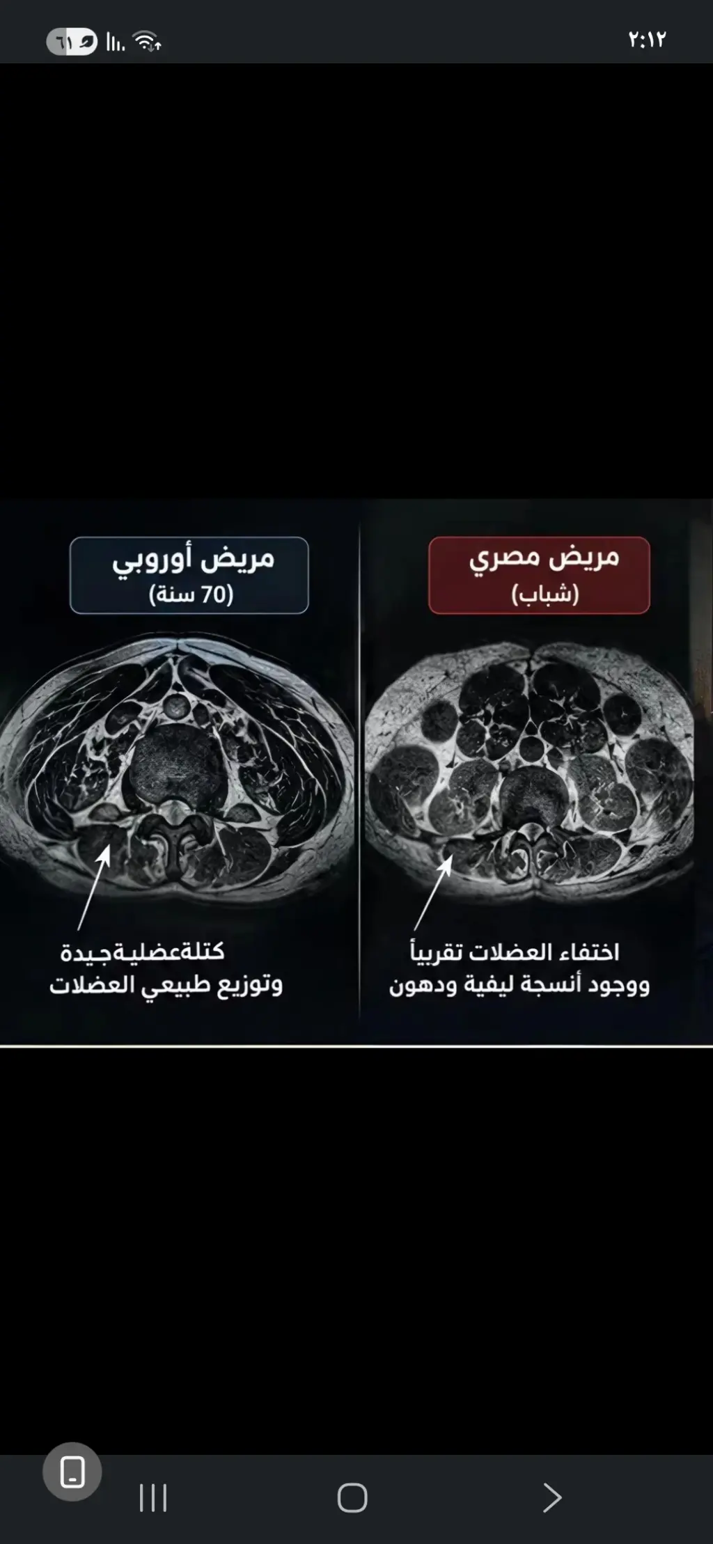 ضمور العضلات لدى الشباب المصريين: ماذا تقول الأرقام الموثقة وما الذي لم يثبت بعد؟