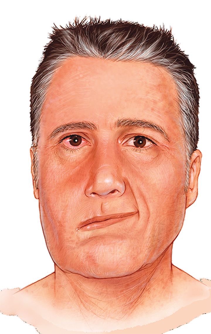  تعرف على أسباب شلل العصب السابع (Bell's palsy)أو 